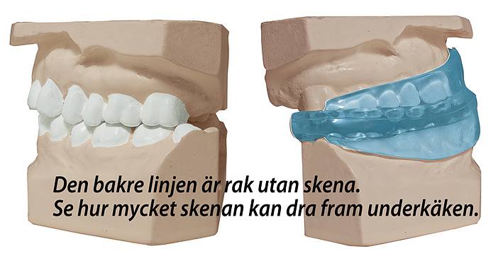 ReduZnore Soft (boil & bite) snarkskena | Dormitek Medical